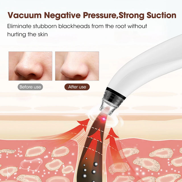 TouchUp And More: Wireless Camera Blackhead Remover
